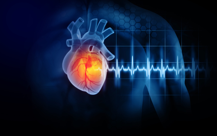 La Mortalidad Por Un Primer Infarto Es Un 20 Por Ciento Superior En Una